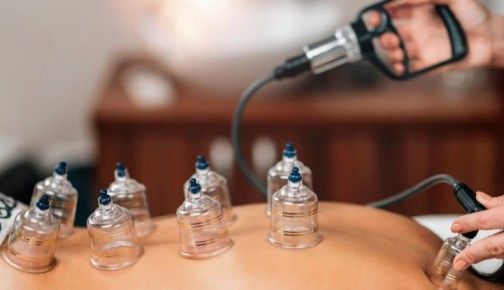 Cupping Therapy